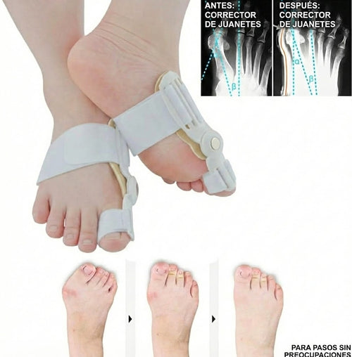 Corrector Ortopédico de Juanete Ajustable – Uso Diario